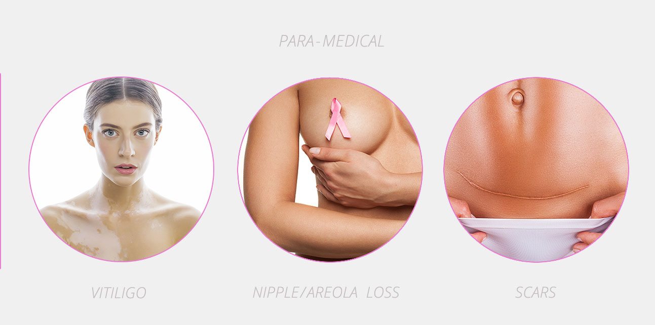Para-medical micropigmentation as a great help in camouflaging surgery and accident scars, nipple restoration and improving skin discolorations related to vitiligo.