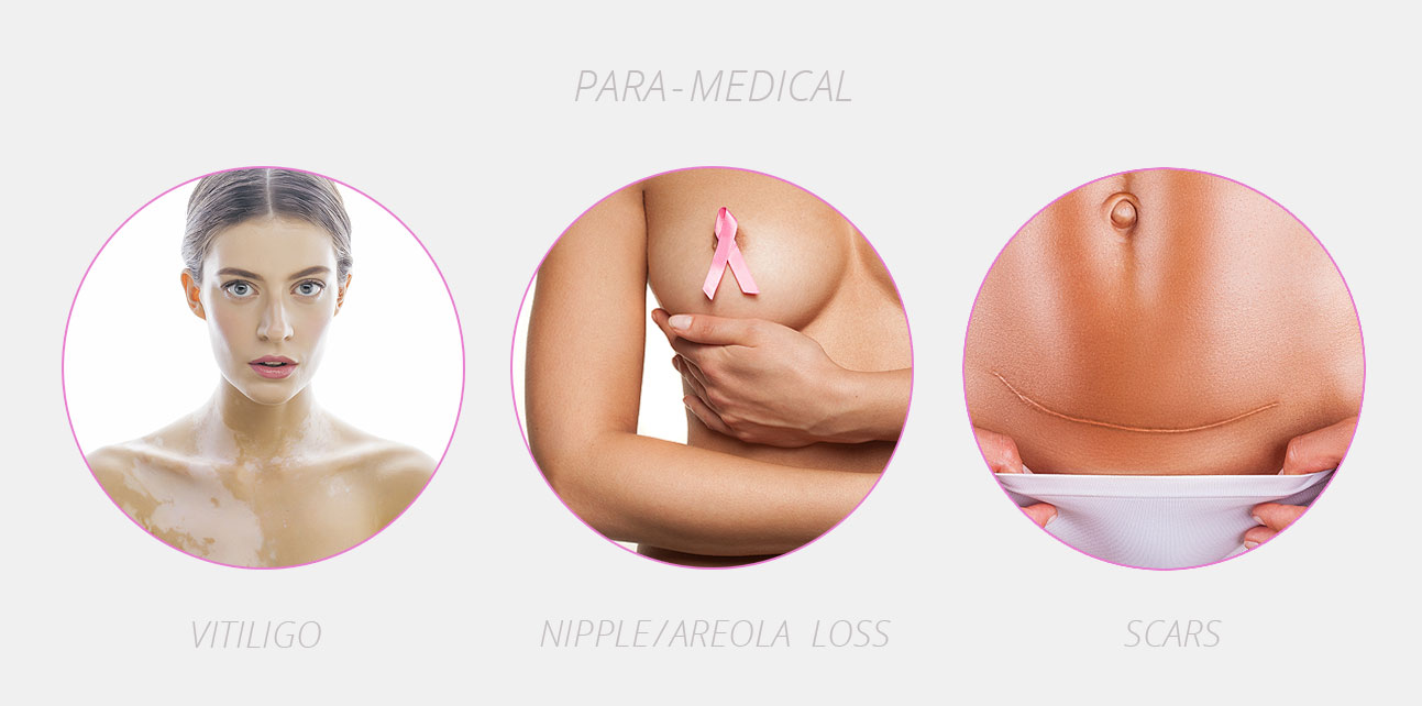 Para-medical micropigmentation as a great help in camouflaging surgery and accident scars, nipple restoration and improving skin discolorations related to vitiligo.